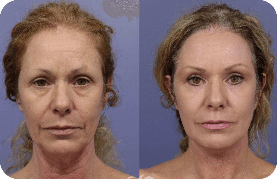 Side-by-side example of a woman's skin appearance